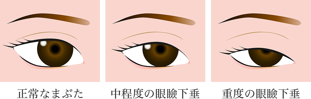 目の病気 眼瞼下垂 がんけんかすい について ビクアスクリニック
